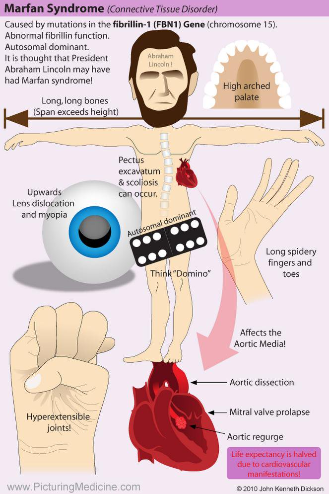 <p>Autosomal dominant <span>connective tissue disorder caused by mutations in the fibrillin 1 gene.</span></p>