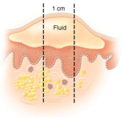 <p>What type of skin lesion is this?</p>