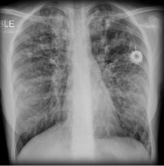 <p>Cystic fibrosis</p>