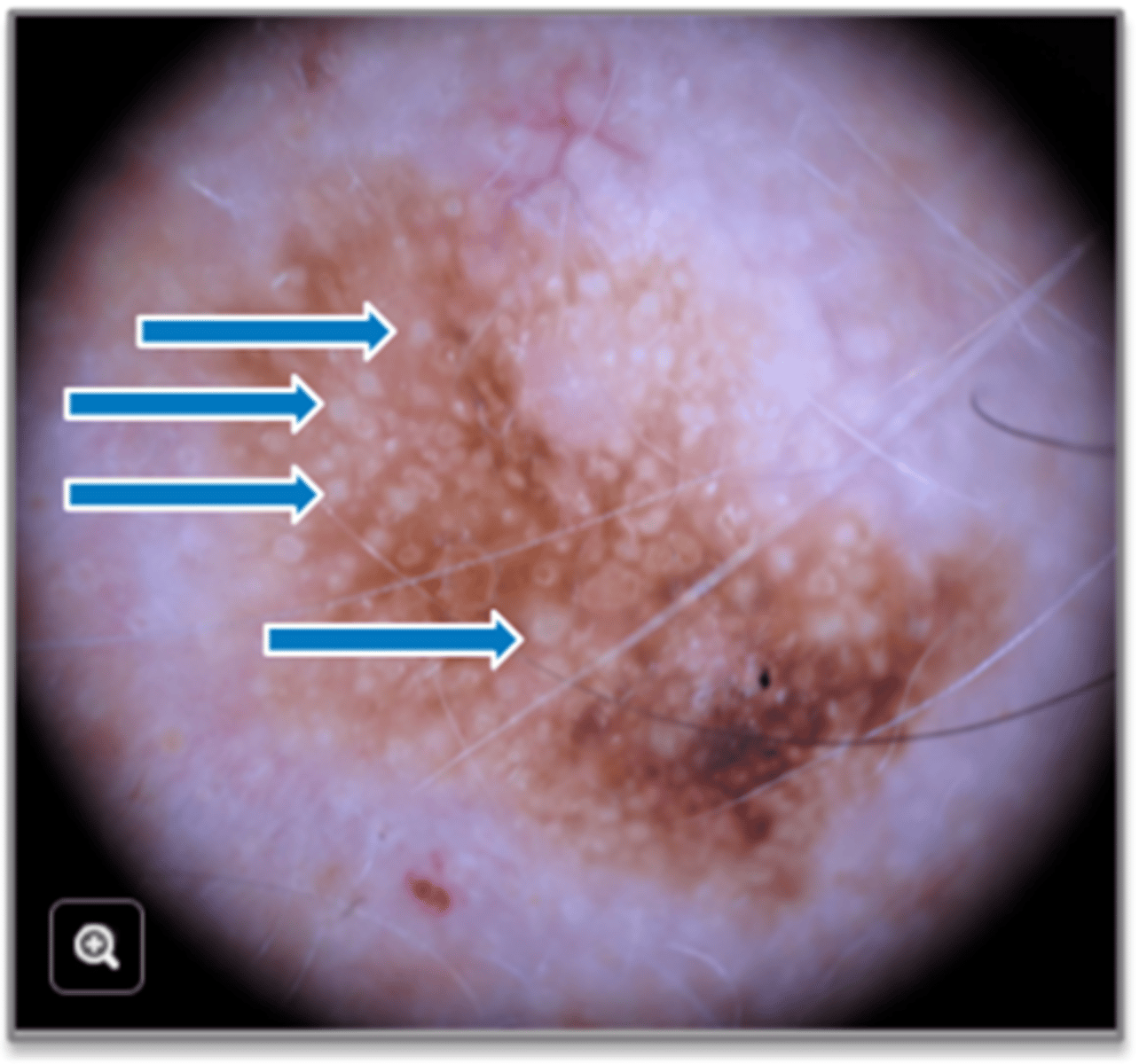 <p>What are SK findings under dermoscopy?</p>