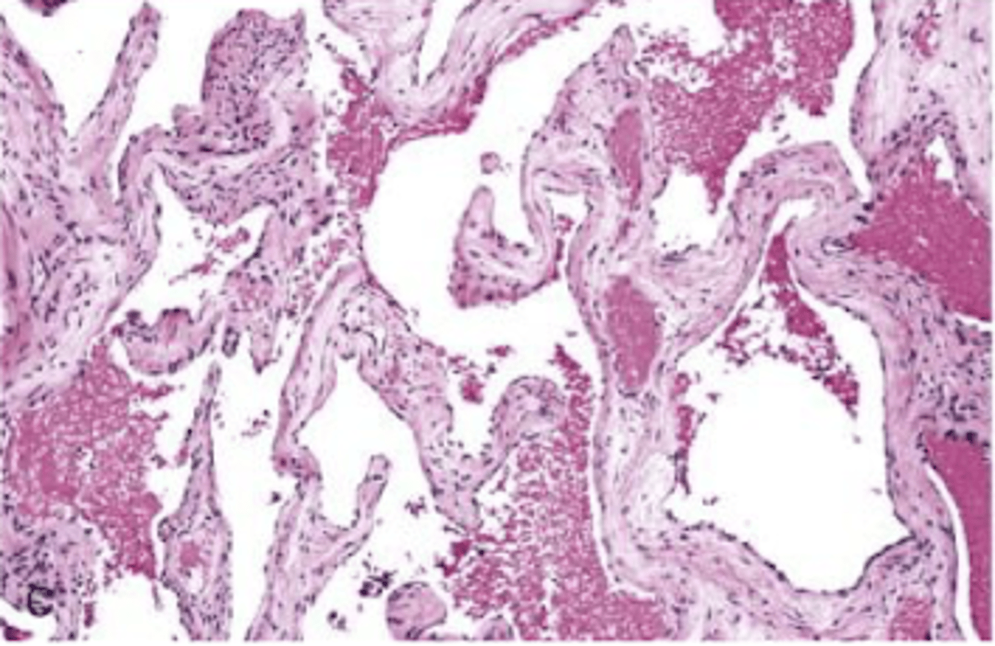 <p>large blood filled dilated vascular changes with CT stroma</p><p>do not regress</p>