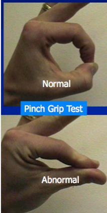 <p>AIN Entrapment presentation muscle involvement</p>
