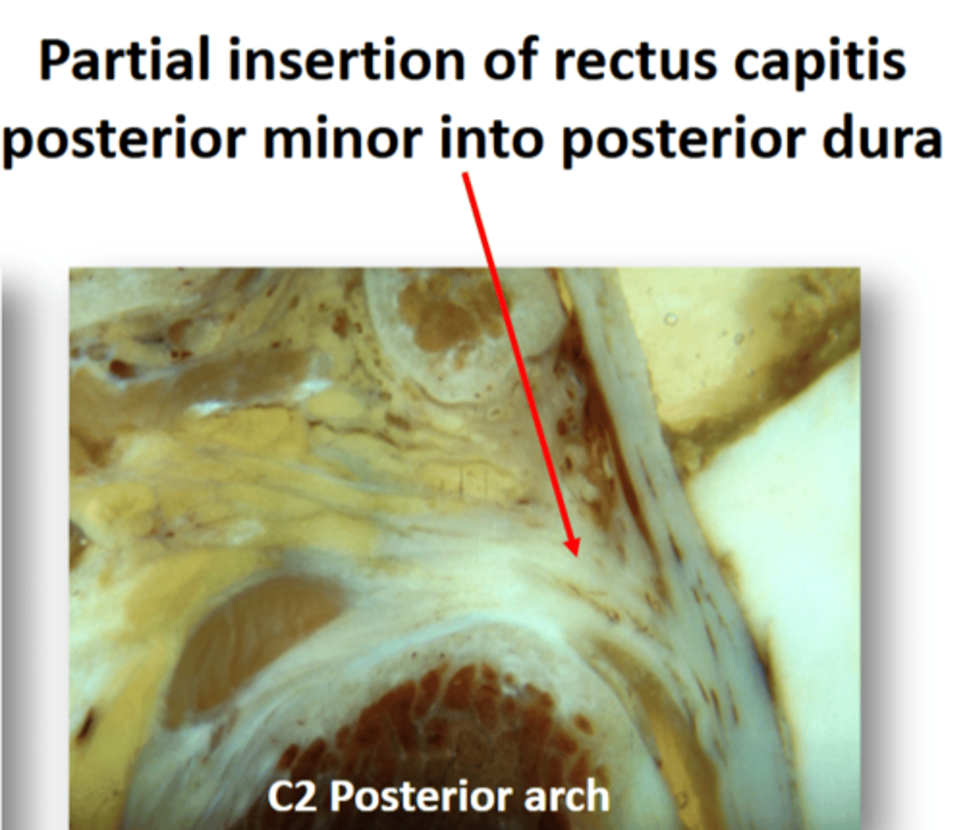 <p>a small tendon from rectus capitis posterior minor inserts into the posterior dura</p><p>- keeps posterior dura tight when the neck is extended</p><p>- the direct attachment can be a source of headaches</p>
