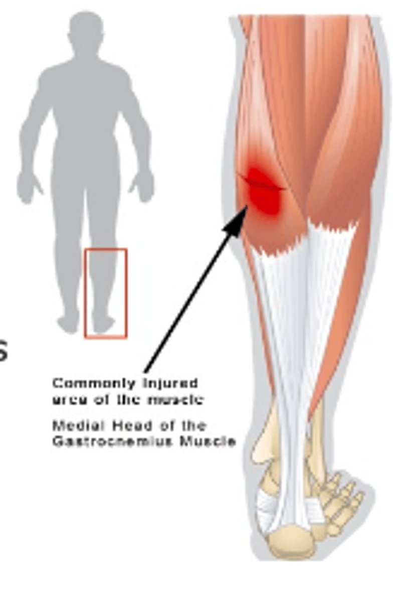 <p>Pulling/tearing sensation in the calf</p><p>Pain is proximal + medial</p>