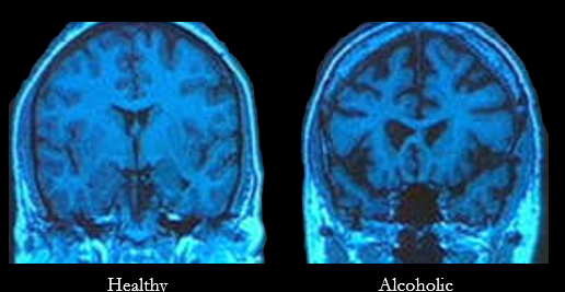 <p>big spaces and loss of tissue - sulcal widening (spaces between gyri), enlarged ventricles</p>