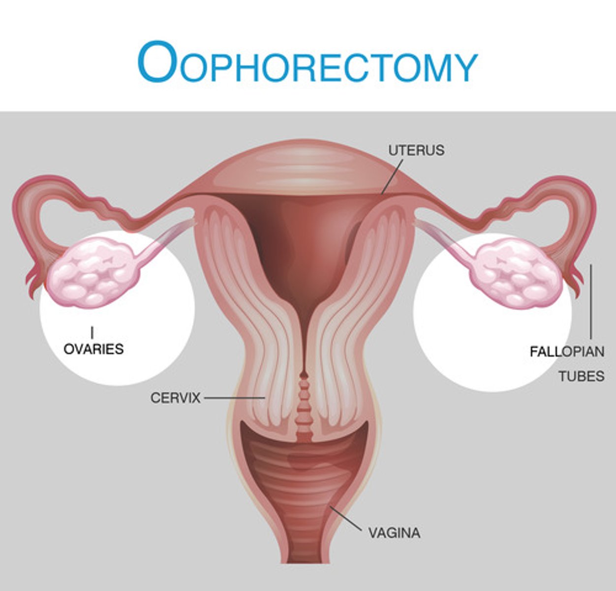 <p>removal of ovary</p>