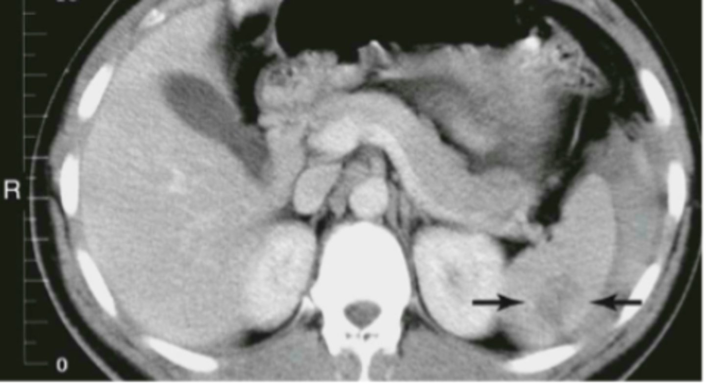 <p>hemorrhage and hematoma present, dark fluid is blood surrounding spleen</p>