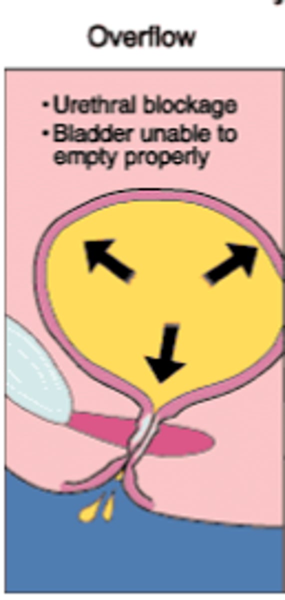 <p>Loss of urine when intra-bladder pressure exceeds the urethra's capacity to remain closed due to urinary retention.</p><p>Caused by outflow obstruction secondary to narrow/obstructed urethra from prolapsed pelvic organ, stricture, enlarged prostate, chronic constipation, or neurological disease.</p><p>Sxs: Difficulty initiating urine stream, weak stream with post-void dribble when initiated.</p><p>Tx: Double voiding for patients with weak detrusor. Surgical intervention for obstruction</p>