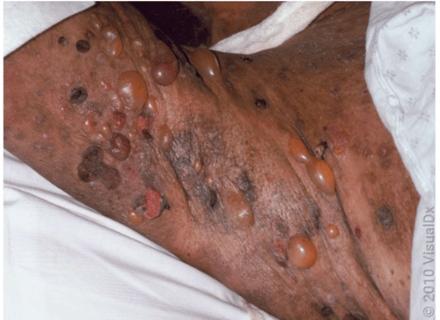 <p>- autoimmune blistering disorder characterised by tense subepidermal blisters</p><p>- usually affects individuals over 60. </p><p>- prodromal phase that involves inflammation of the affected skin, making it very itchy</p>