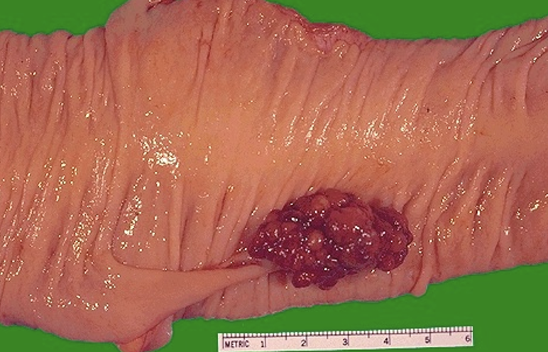 <p><span><span>Describe the gross appearance.</span></span></p><p style="text-align: left;"><span><span>What is the cell of origin?</span></span></p><p style="text-align: left;"><span><span>What is the diagnosis?</span></span></p><p style="text-align: left;"><span><span>What is the clinical significance?</span></span></p>