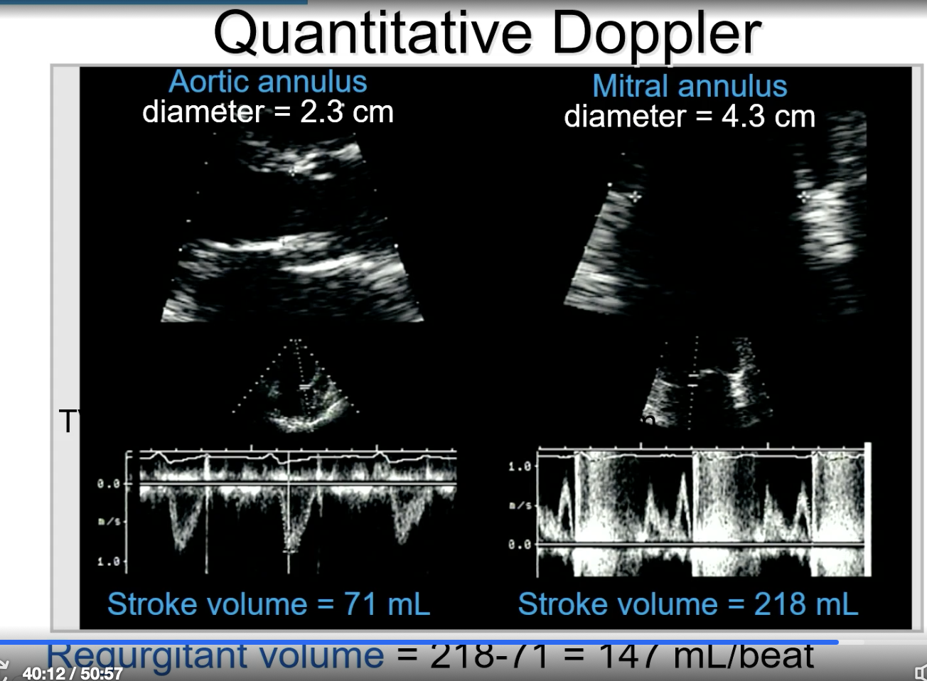 <p>FYI when obtaining the PW for the SV measurement of the aortic valve, you measure the outline of the pulse wave. For the mitral valve, you kind of measure more inward on the line of the entire “M” shape. </p>