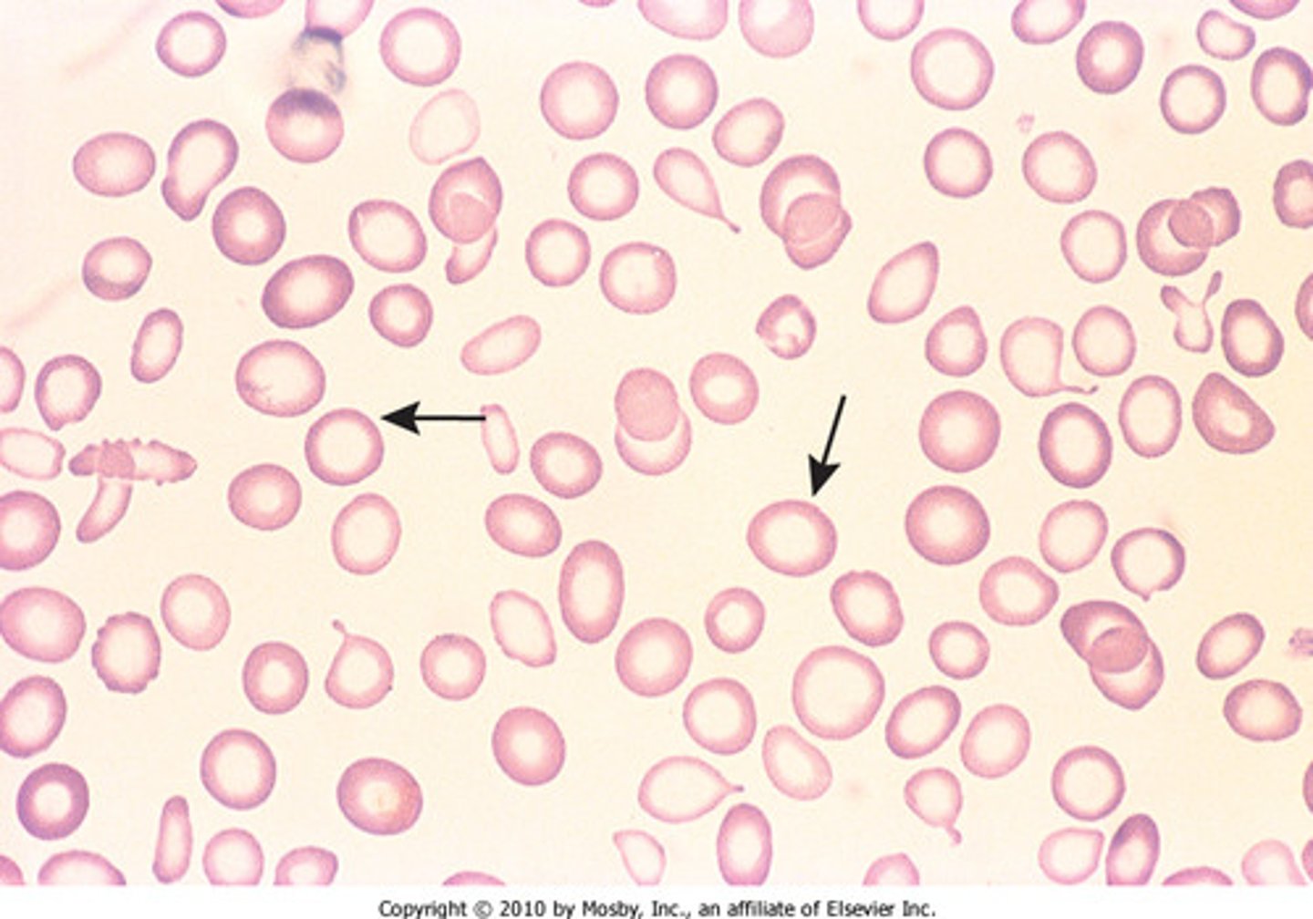 <p>anemia caused by inadequate iron intake or chronic blood loss</p>