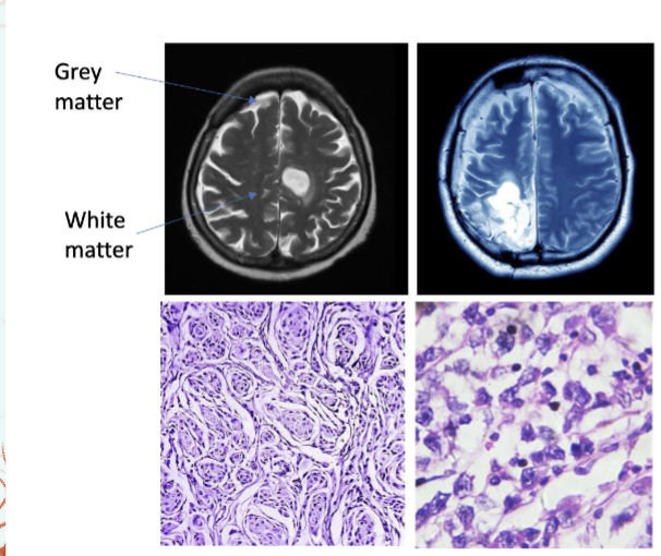 <p>Diseases of the Astrocyte</p>