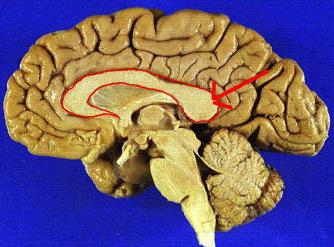 Large commissural tract that connects the cerebral hemispheres allowing for communication 