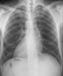 <p>What is Dextrocardia?</p>