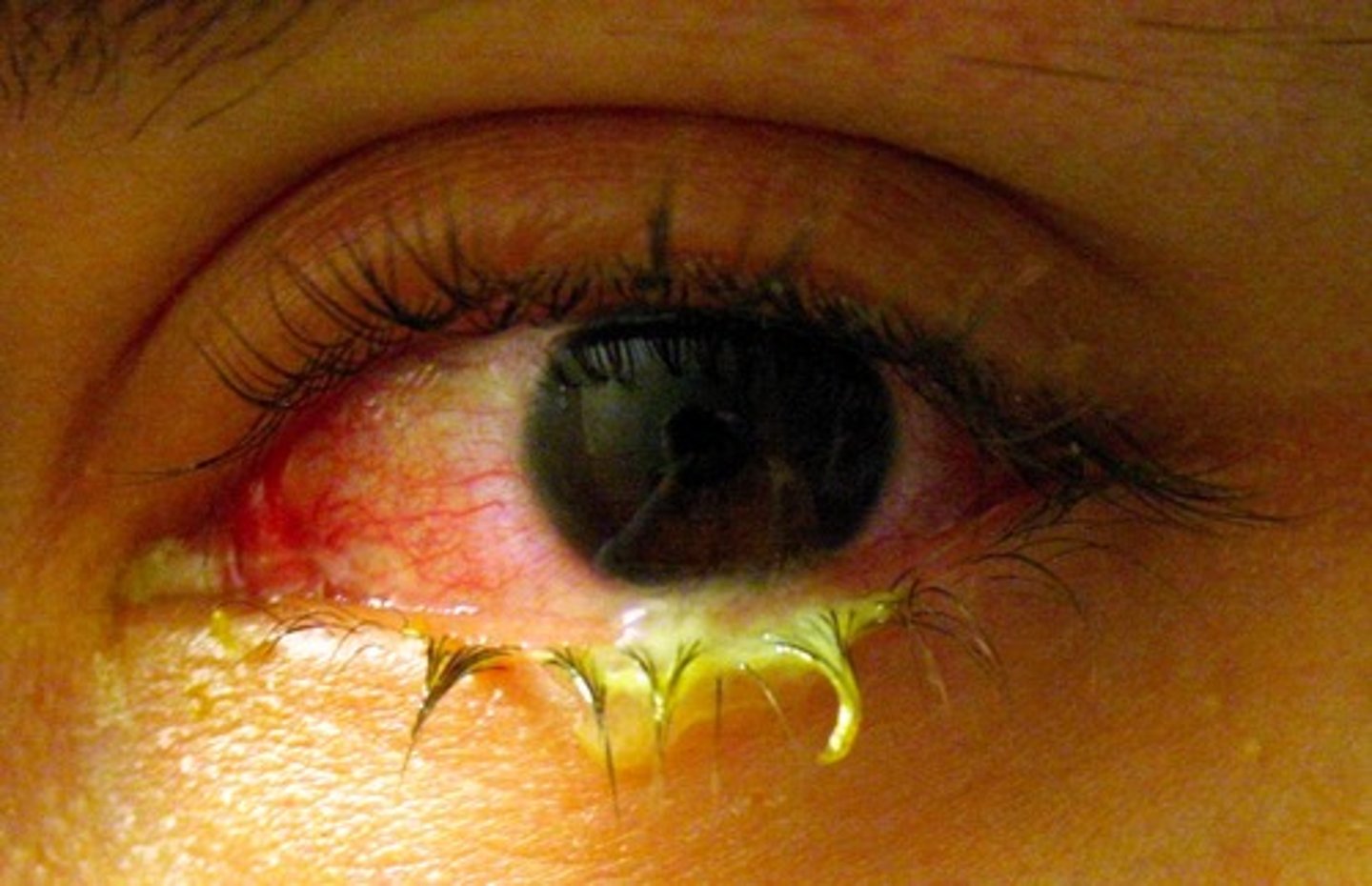 <p>inflammation of the conjunctiva (pink eye); Infection of the conjunctiva usually due to bacteria or virus but which may result from chemical exposure.</p><p>the eye will have liquid coming out</p>