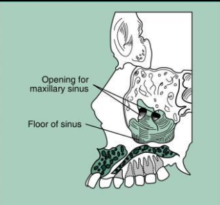 <p>Maxillary sinus </p><ul><li><p>paired cavities of the bone located within the maxilla above the maxillary premolar and molar teeth</p></li><li><p><u>Radiography:</u><strong><u> radiolucent</u></strong><u> area located above the apices of the max premolar and molars. </u></p></li></ul><p></p>