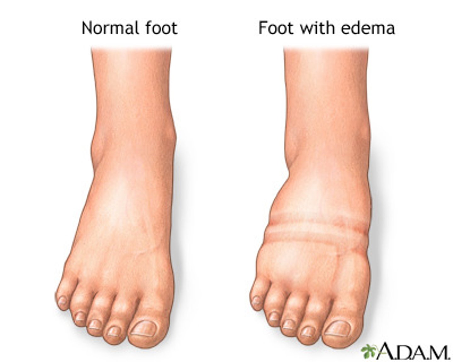 <p>Swelling caused by excess fluid trapped in your body's tissues; Quantified as 1+, 2+,3+ during a physicians physical exam</p>