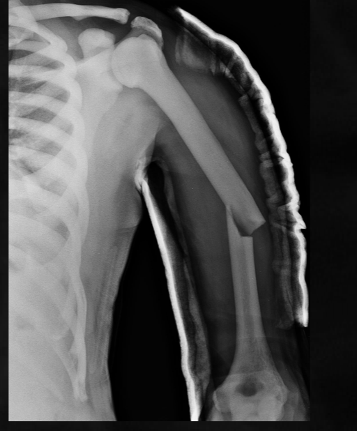 <p>what is seen here for this case of osteopetrosis?</p>