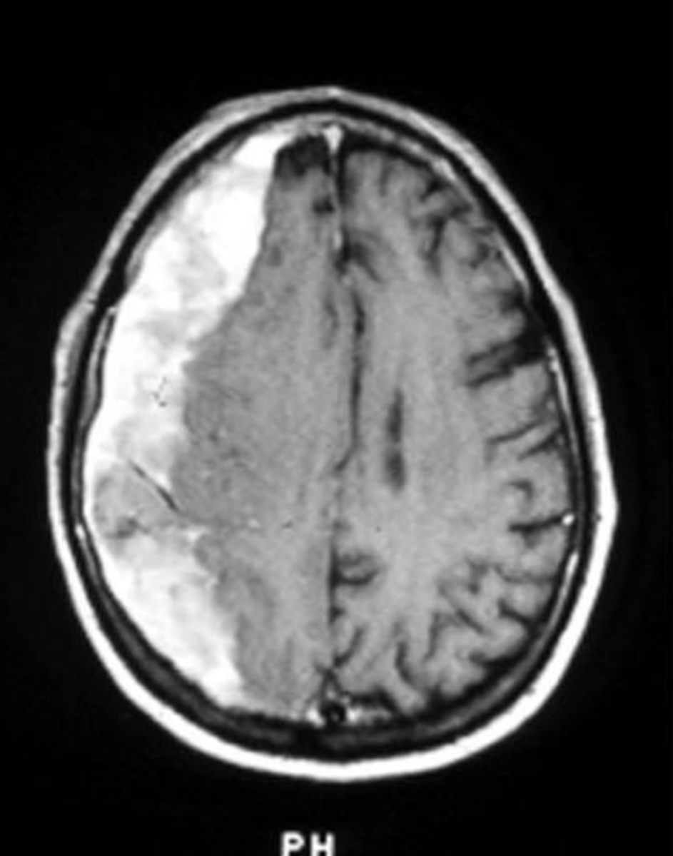 <p>White, crescent-shaped mass between the inner part of the skull &amp; surface of the central hemisphere</p>
