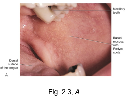 <ul><li><p>on the surface of the labial and buccal mucosa is a common variation, fordyce granules</p></li><li><p>these are visible as small yellowish elevations in the oral mucosa</p></li><li><p>they represent deeper deposits of waxy <strong>sebum </strong>from trapped or misplaced sebaceous gland tissue</p></li></ul><p></p>