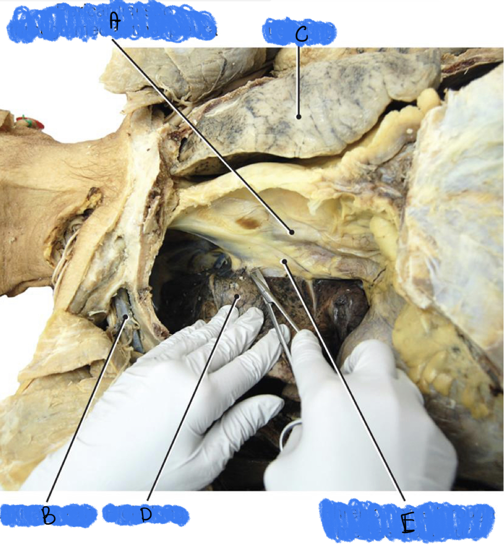 Which letter is the Pericardial sac through mediastinal pleura? 