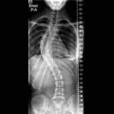 <p>Abnormal Lateral curvature of the spine, often forming a “s” or “c” shape</p>