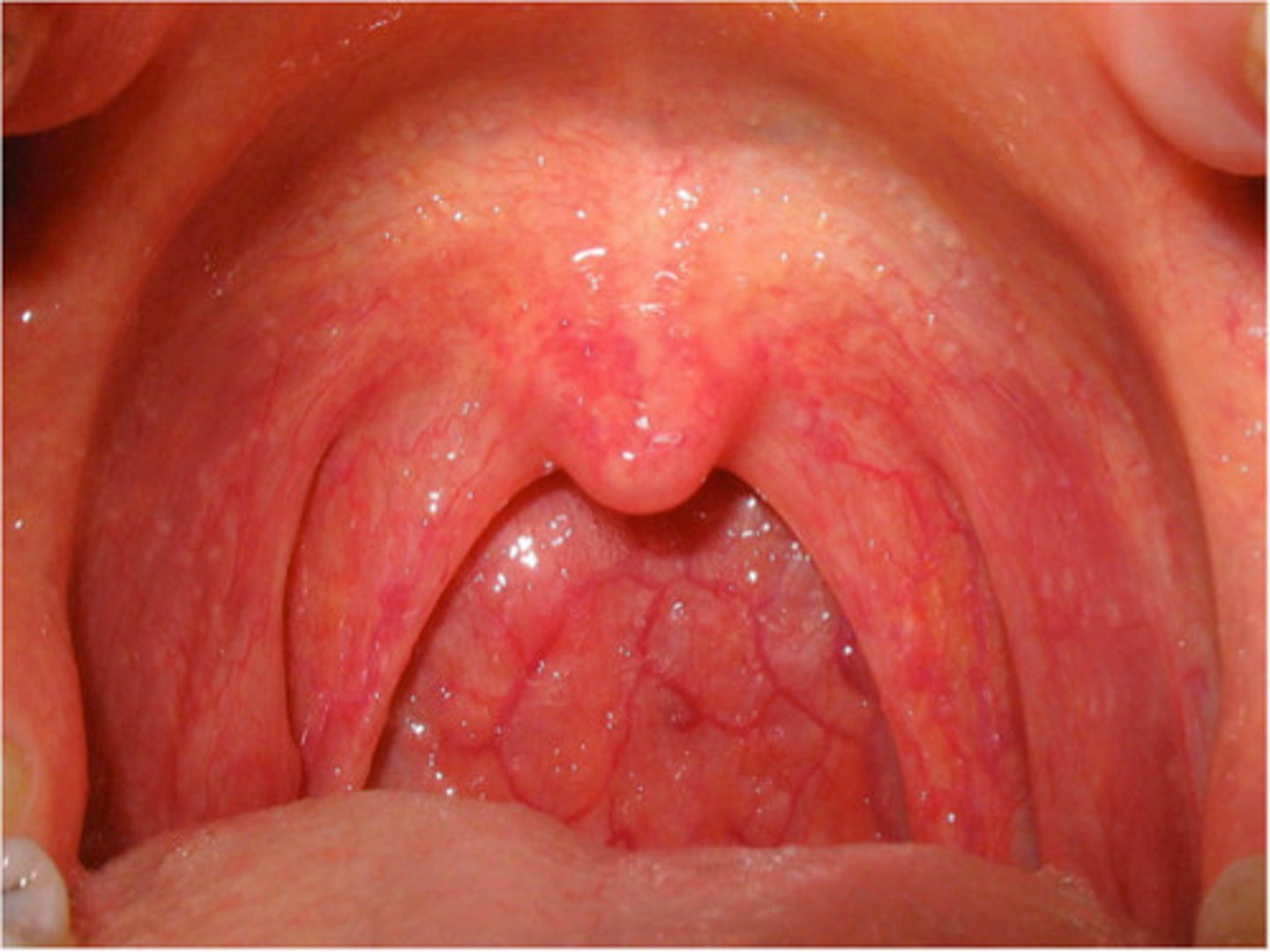 <p>red throat without exudate</p>