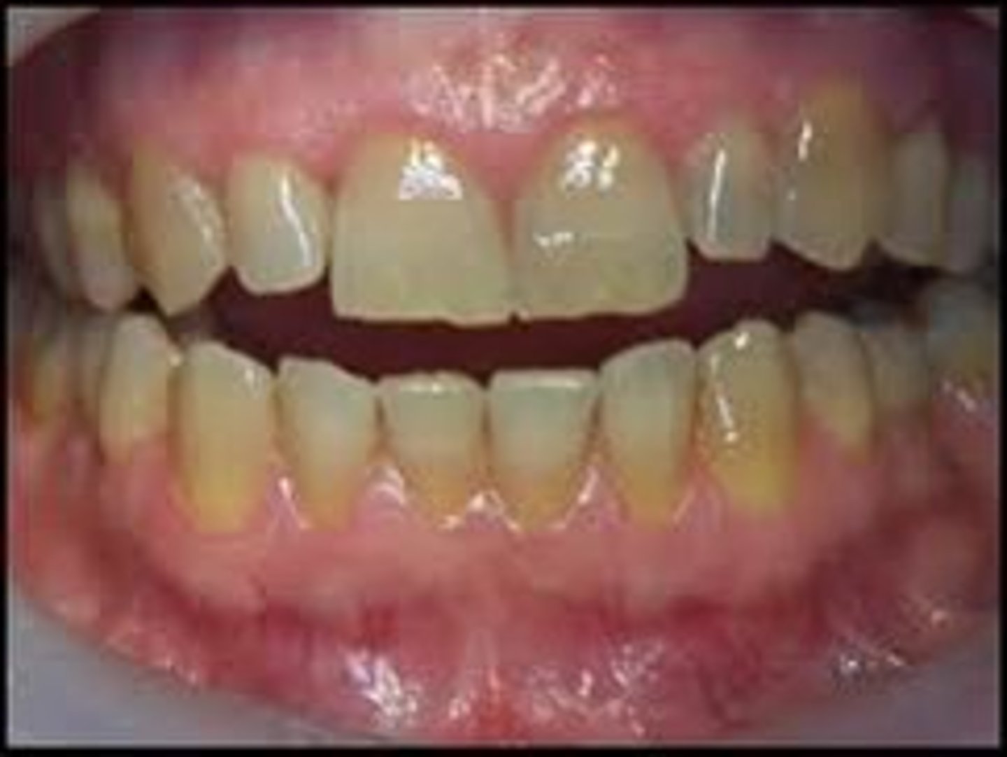 <p>Dull, yellowish discoloration of dental biofilm</p>