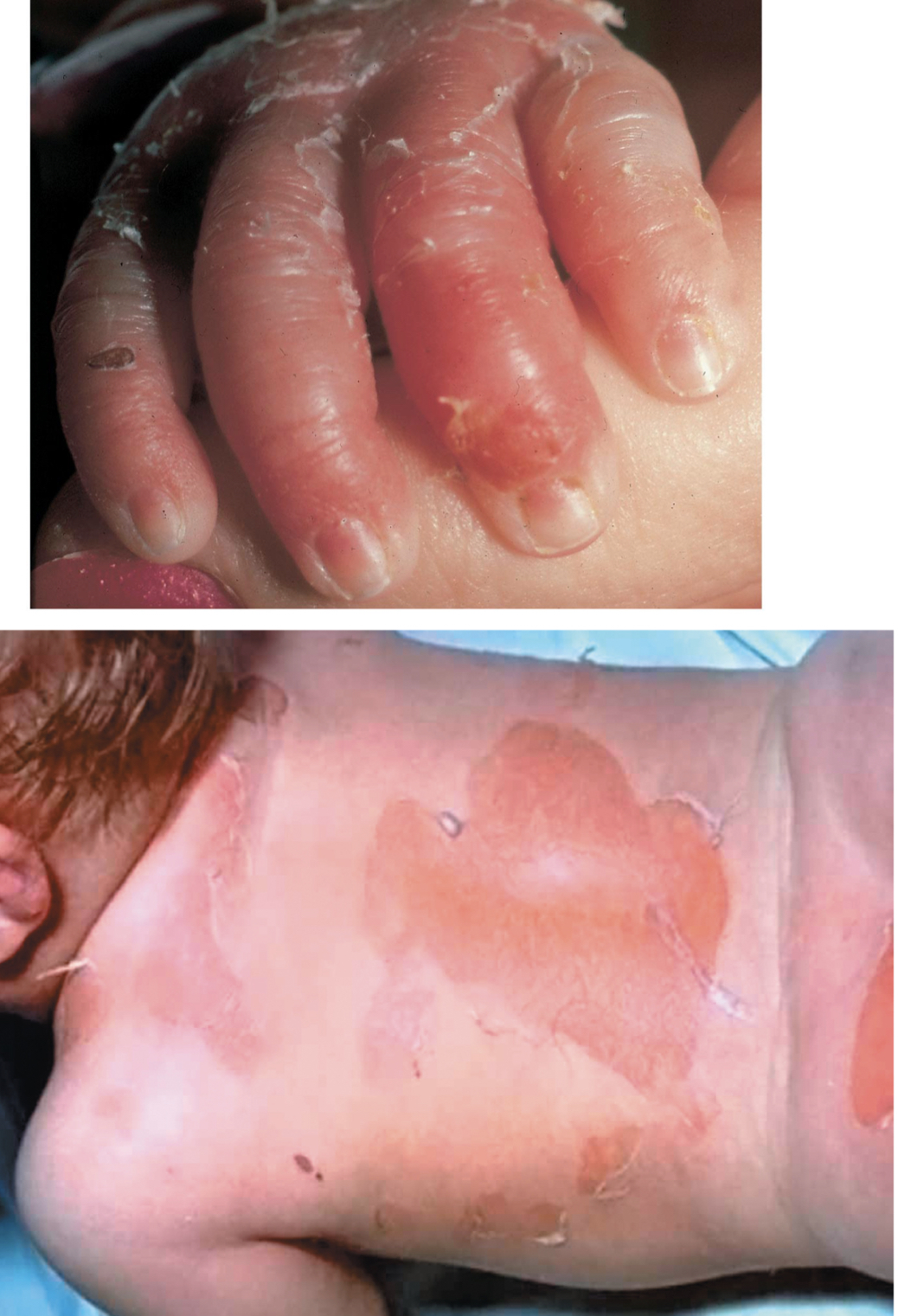 Scalded skin syndrome: Staphylococcal skin infection