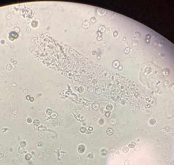 <p>What type of cast is this?</p><p>What is the cell seen on the top right corner?</p><p>Be able to identify RBCs &amp; Yeast on this slide</p>