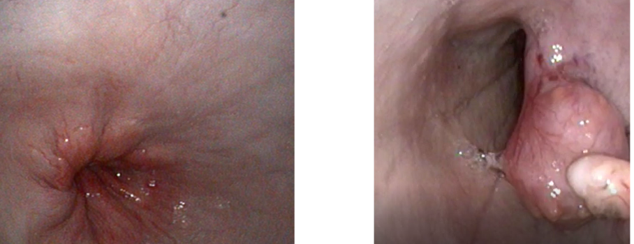 <p>can identify/look for esophageal disease, foreign bodies, strictures</p>