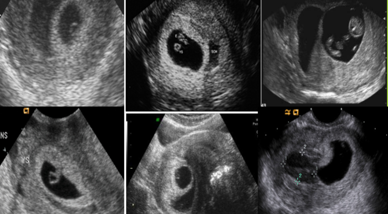 <p>Fluid collection between gestational sac and uterine wall</p>