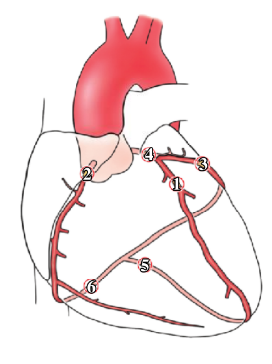 <p>-blockages in the coronary arteries likely to result in ischemia because they are functional end arteries; usually insufficient anastomoses with adjacent vessels to compensate for the lack of oxygen</p><p>-ischemia stimulates the sensory endings in the heart (cutting the heart or temp fluctuations do not cause cardiac pain)</p><p>-blockages may be due to transient platelet aggregation, vasospasm, a blood clot (thrombus), or rupture of a vulnerable atherosclerotic plaque</p><p>-blockages most common in anterior interventricular (LAD), right coronary, and circumflex arteries</p><p>-blockages may be asymptomatic, cause angina pectoris with transient pain, or a MI in which there are prolonged pain and permanent damage to heart muscle</p>