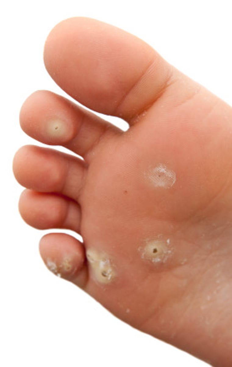 <p>occur on the plantar surfaces of the feet. because of the forces on the feet from walking, the warts grow into the foot and become calloused (harder to treat, harder to eradicate)</p><p>can be very painful if walked on a lot</p><p>may resolve spontaneously with no therapy</p><p>in immunocompromised patients, may be widespread and intractable</p>