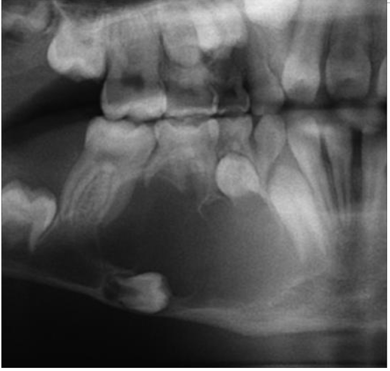 <p>A 35 year old patient present with mild swelling of lower jaw. Intra orally a small swelling was visible over left third molar region.</p>