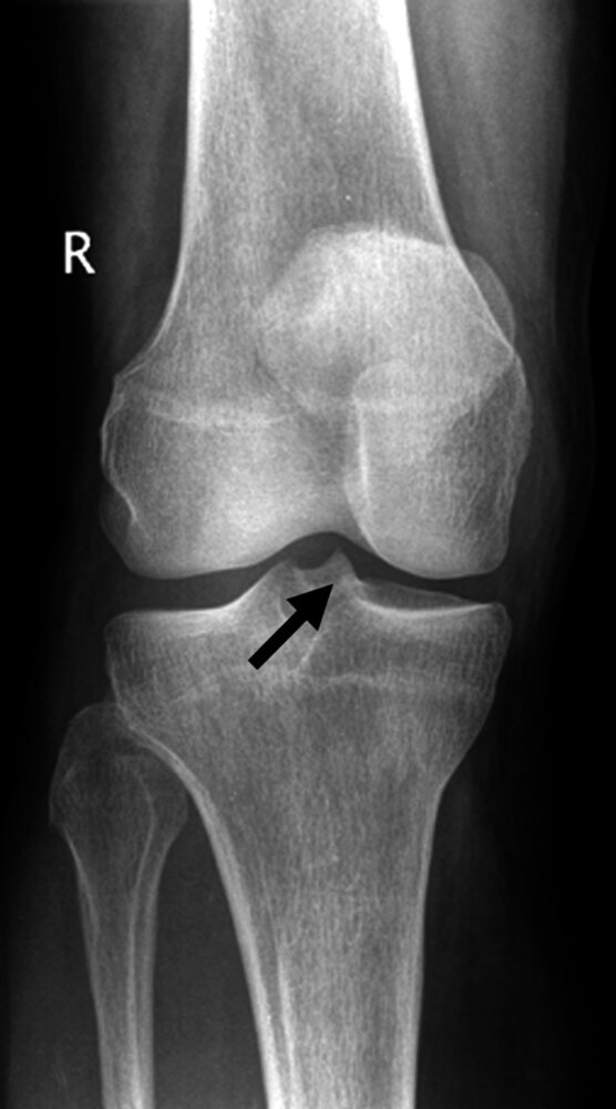 <p>27. The arrow in the X-ray image shown marks the bone attachment, origin, or anchoring point of the:</p><p>A. Anterior cruciate ligament (ACL)</p><p>B. Patellar ligament</p><p>C. Popliteus muscle</p><p>D. Soleus muscle</p><p>E. Iliotibial tract</p>