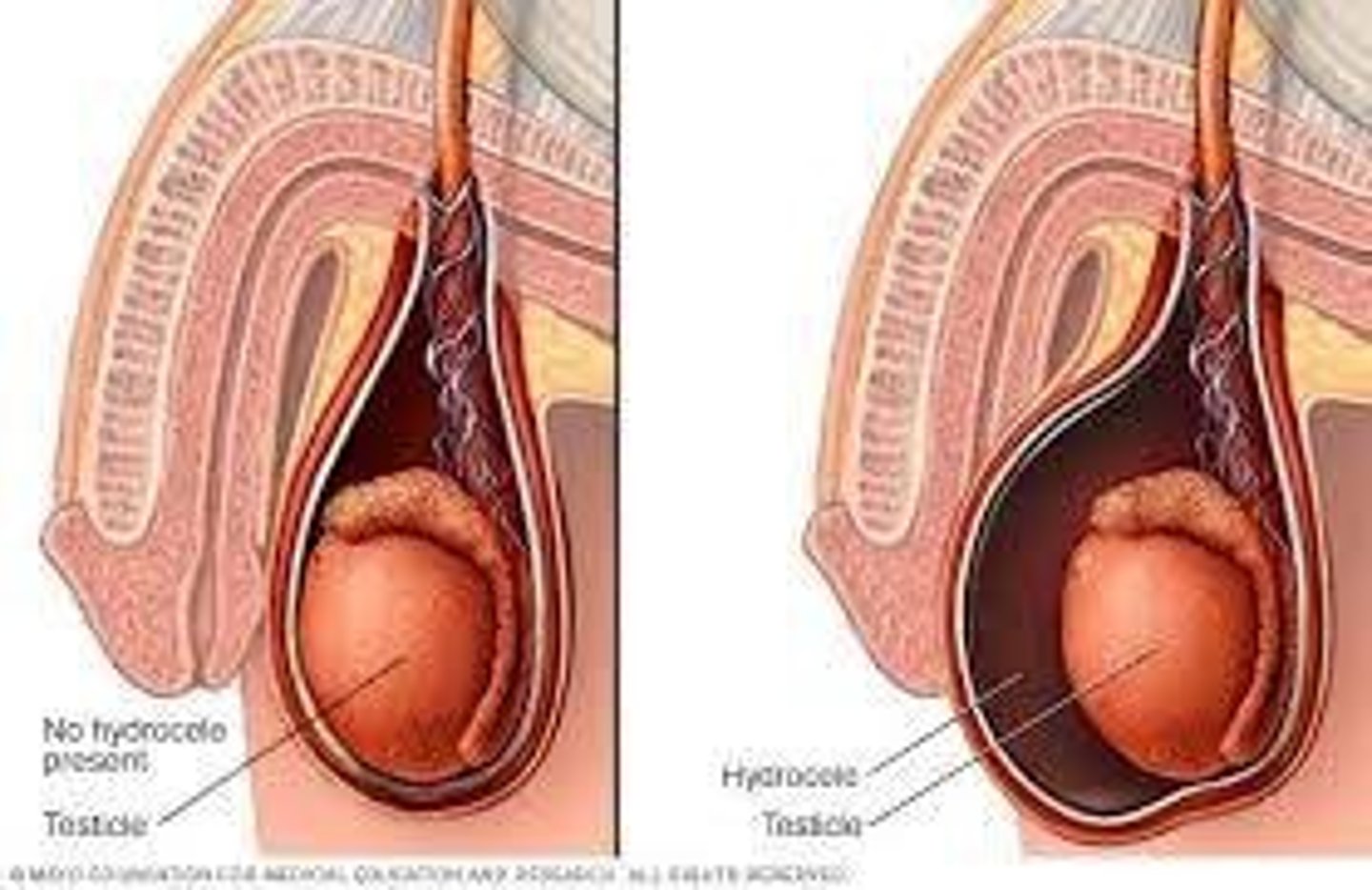 <p>Fluid collection along the spermatic cord or within the tunica vaginalis.</p>