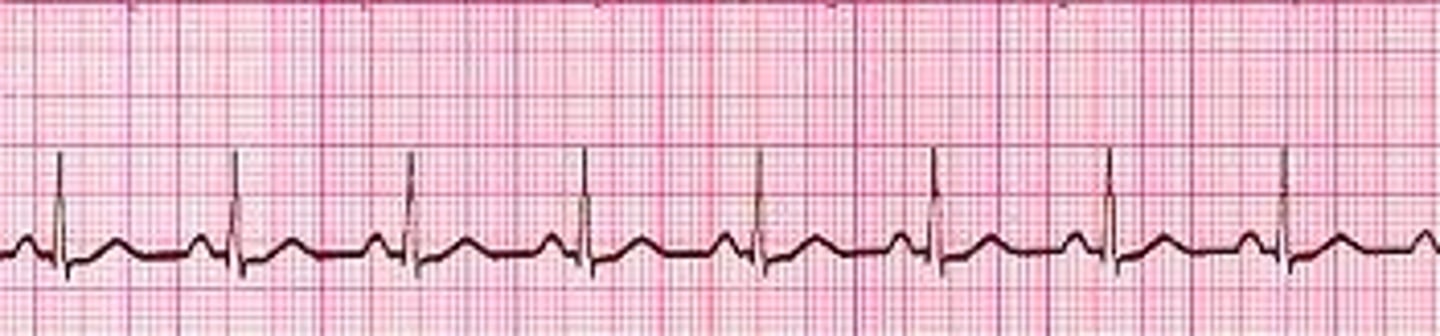<p>60-100 bpm</p><p>all complexes normal and evenly spaced (P, QRS, T)</p>