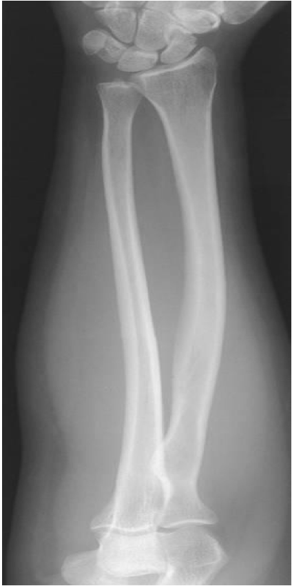 <p><span style="line-height: normal;"><span>• </span></span>Carpals to distal humerus included</p><p class="p1"><span style="line-height: normal;"><span>• </span></span>Humeral epicondyles are in profile.</p><p class="p1"><span style="line-height: normal;"><span>• </span></span>Only slight, if any, superimposition of distal radioulnar joint</p><p class="p1"><span style="line-height: normal;"><span>• </span></span>Radial head, neck and tuberosity are slightly superimposed over the proximal ulna</p><p class="p1"><span style="line-height: normal;"><span>• </span></span>Open space b/w shafts of radius and ulna</p>