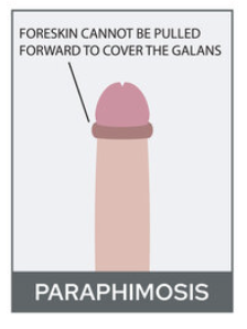 <p>inability to withdraw penis into the prepuce </p>