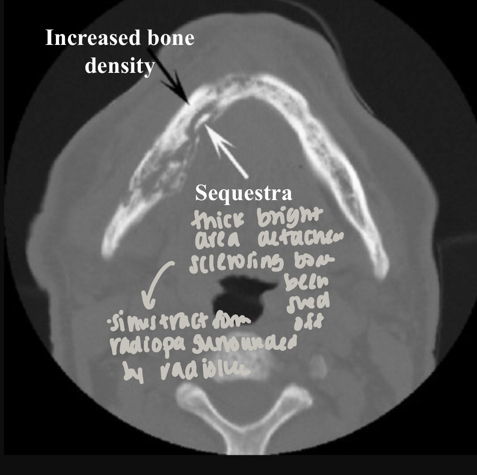 <p>which osteomyelitis phase? </p><p>internal structure:</p><ul><li><p>sequestration, sinus tract or fracture </p></li></ul><p></p>