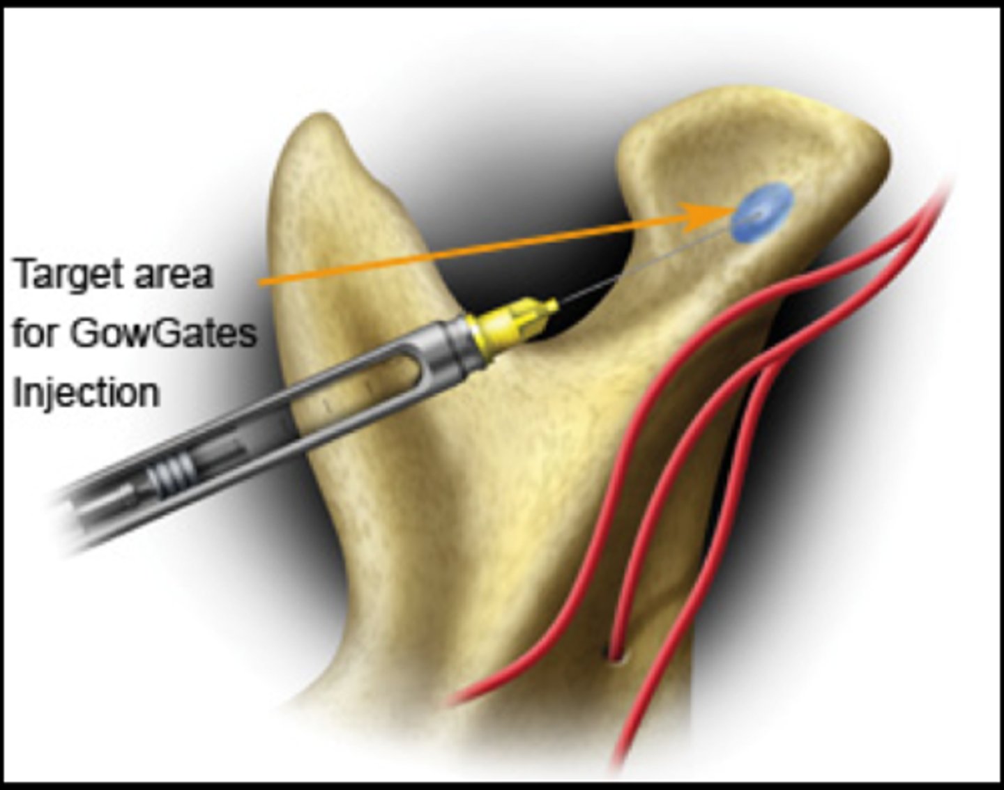 <p>medial aspect of the condyle, higher than the IANB before the CN V3 branches (higher than lingual, long buccal, &amp; IAN)</p>