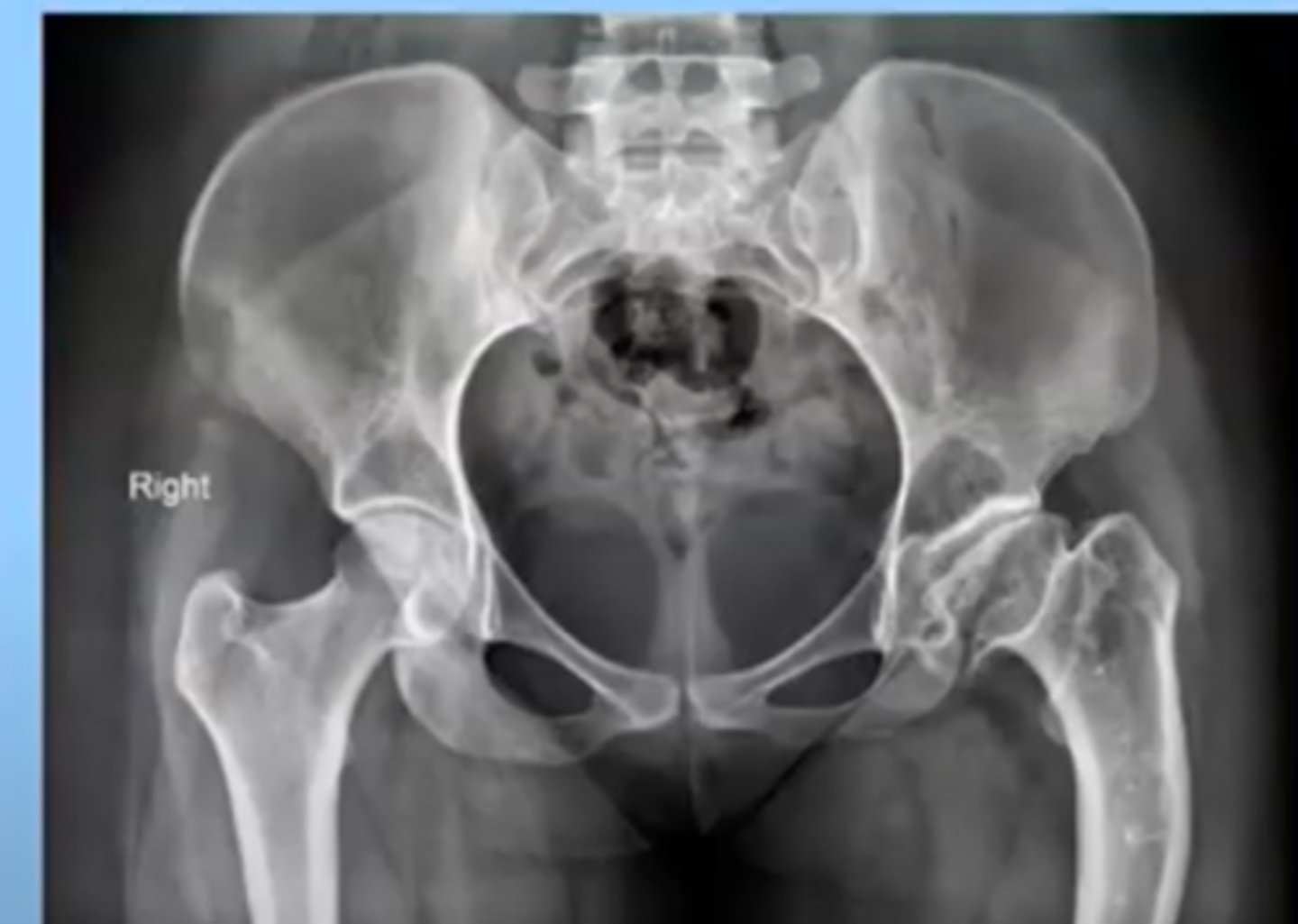 <p>Death of bone tissue because of a disruption in blood supply to the bone</p><p>femoral head of the hip is most common place</p><p>this can cause a fracture or be caused by a fracture or trauma to the bone (Acutely)</p><p>can also happen overtime</p><p>-ex: with a malignancy, chronic alcoholism, long term steroid use</p><p>-often have chronic pain in that area</p>