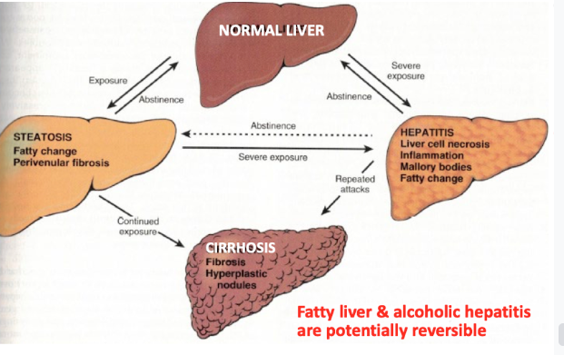 Alcoholic fatty liver → Alcoholic hepatitis → Cirrhosis