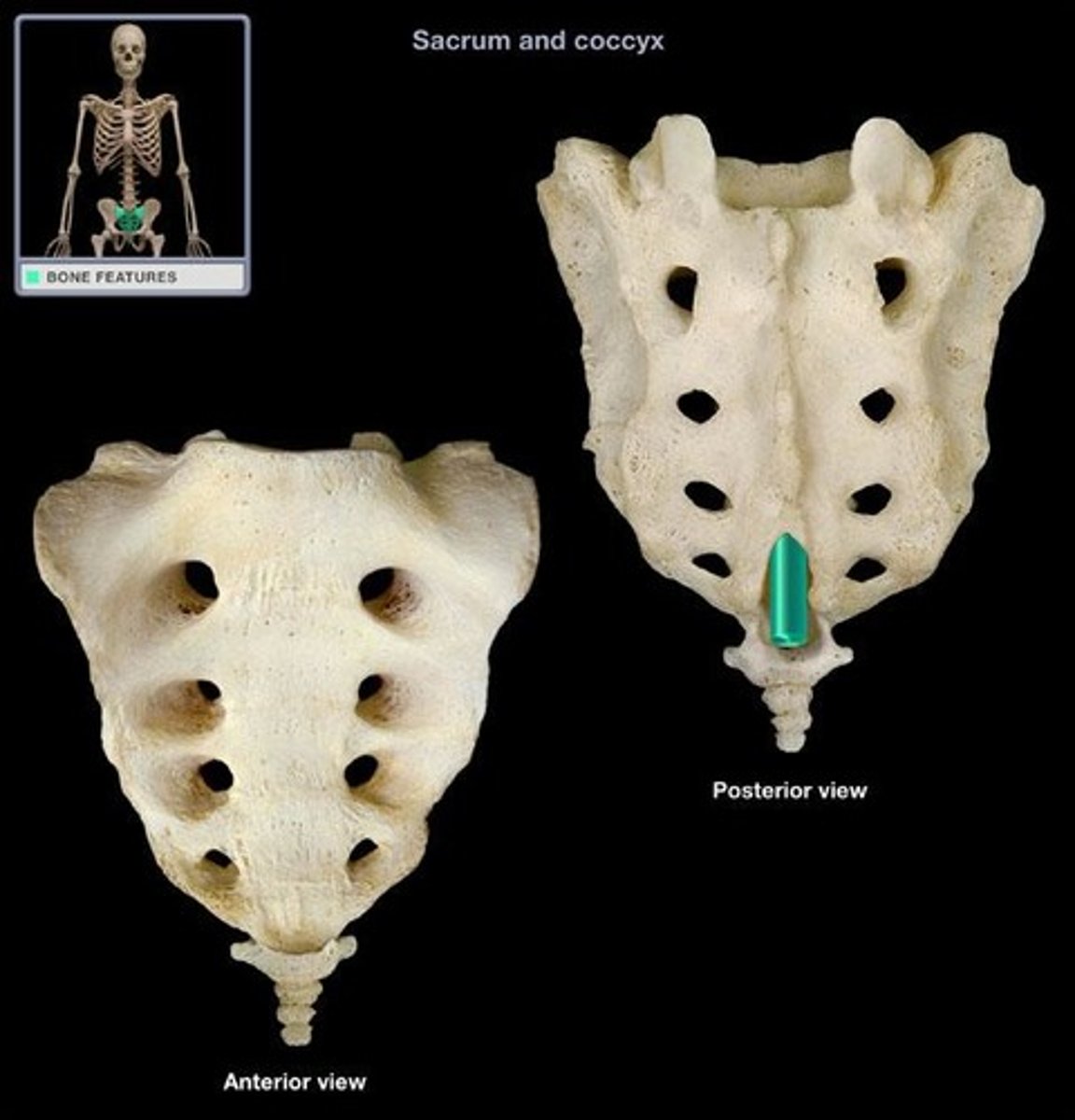 <p>inferior opening of the sacral canal</p>