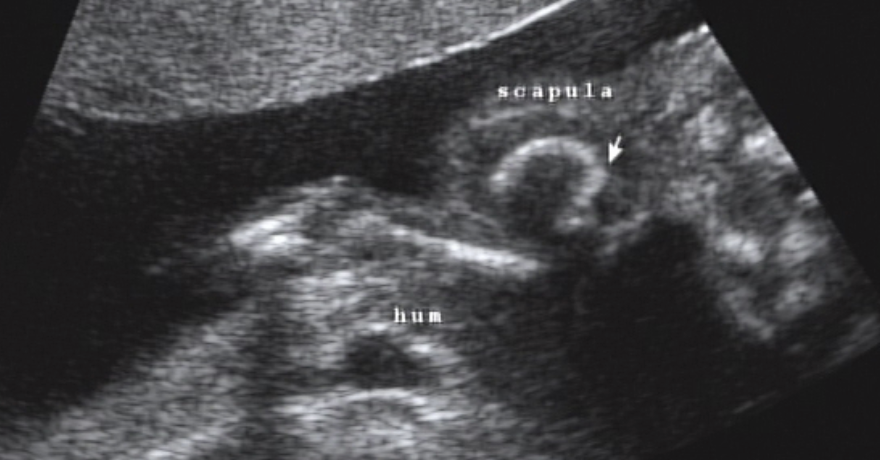 <ul><li><p>not routinely imaged</p></li><li><p><strong>ossification</strong> around <span style="color: rgb(178, 0, 255);">21-27 weeks</span></p></li></ul><p></p>