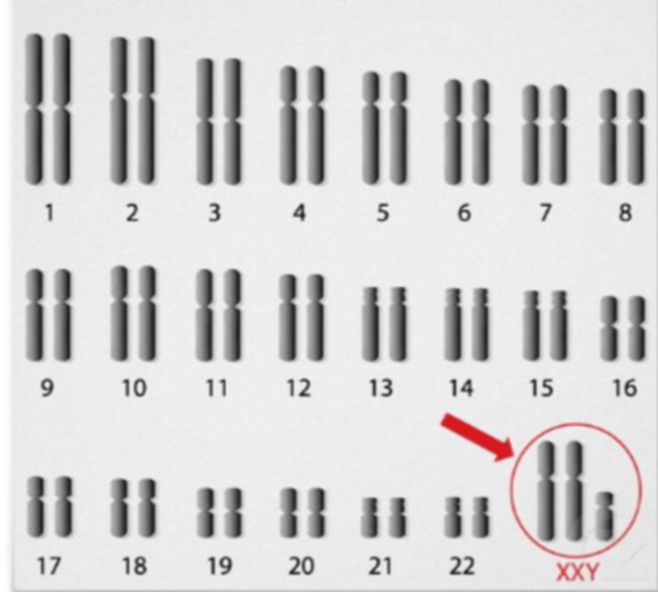 <p>One of most common genetic disorders; male babies are born with an extra X chromosome but typically no symptoms are apparent until puberty; referred to as trisomy 23 (XXY); affects 1 out of every 500 - 1000 males; the extra X chromosome primarily affects the testes, which produce sperm and the male hormone testosterone; lack of testosterone prevents males from exhibiting secondary sex characteristics like facial and body hair and most are sterile; individuals affected are often less muscular, may have learning disabilities; often treated with hormone replacement therapy</p>
