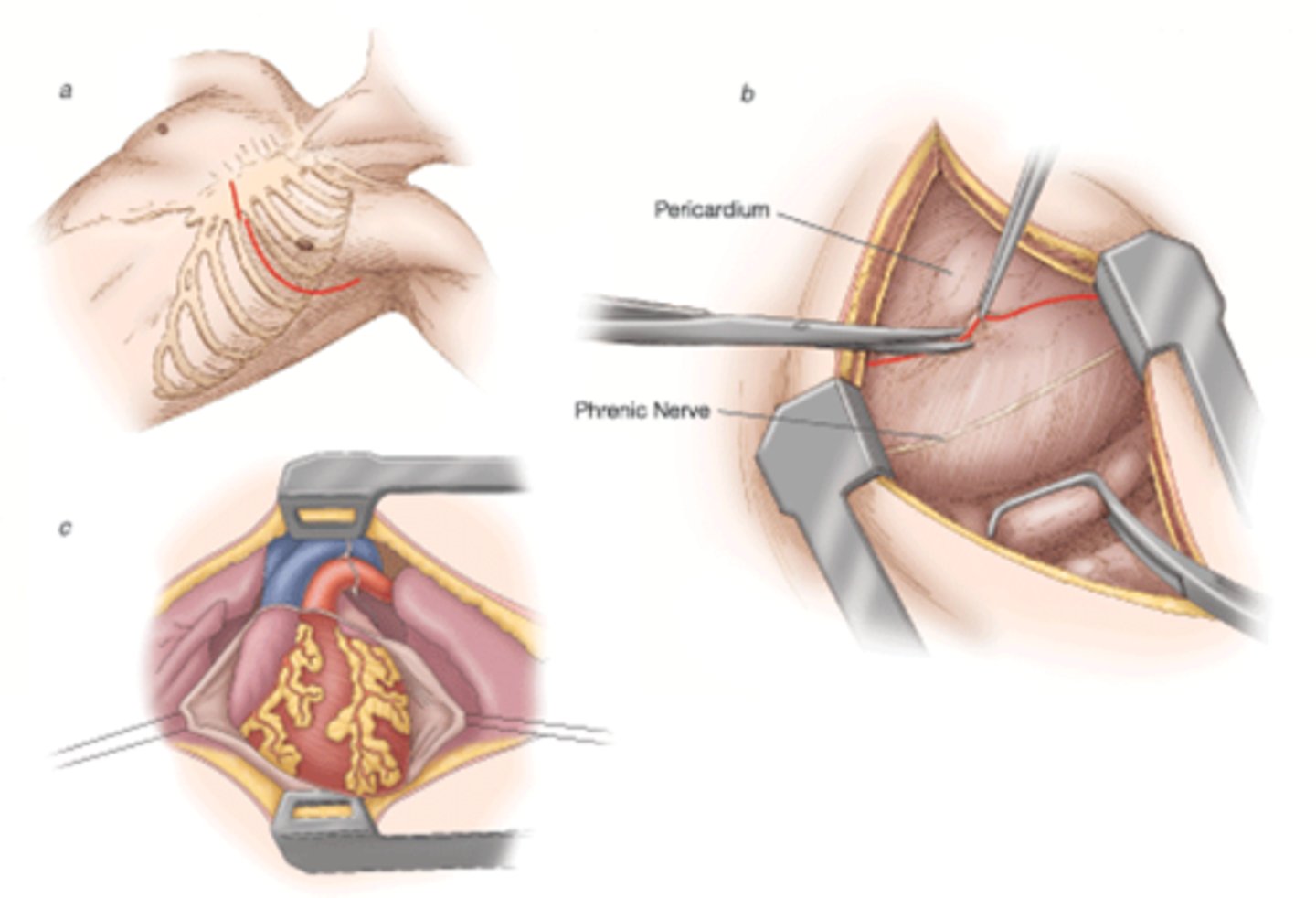 <p>incision into the abdominal cavity</p>