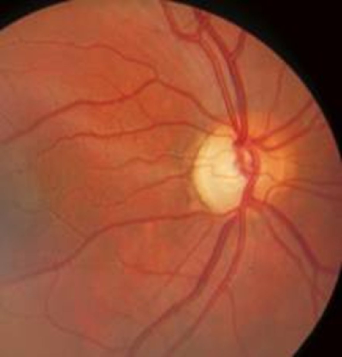 <p>ischemic optic neuropathy</p>